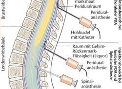 Peridurale anästhesie (pda) wird im sitzenden oder in seitlicher position durchgeführt. Regionalanasthesie Judisches Krankenhaus Berlin