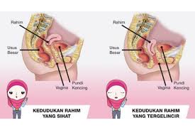 Serviks turun dari kedudukan normalnya sehingga bukaan faraj tetapi rahim masih di dalam faraj. Orang Perempuan Jangan Angkat Barang Terlalu Berat Nanti Jatuh Peranakan Pesona Pengantin