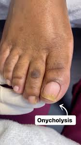 Image result for Onycholysis feet
