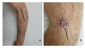 What is merkel cell carcinoma? Cureus Basal Cell Carcinoma Associated With Secondary Localized Cutaneous Amyloid Deposits Case Report And Review