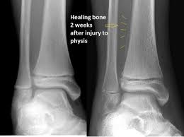 Image result for Growth Plate