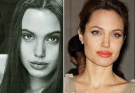 Blepharoplasty Photo Gallery Michele Shermak Md Angelina Jolie Nose Job Angelina Jolie Plastic Surgery Chin Implant