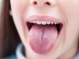 Tim spector recently reported covid tongue as a 'thing' but said it affects less than one in 100. Coronavirus Symptoms These 3 New Symptoms Could Be Early Indicators Of Covid 19 As Per Study