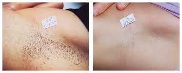 We provide expert laser hair removal treatments in a friendly and professional environment. Laser Hair Removal Wellington Laser Therapy Fl Laser Center Truderm Fl