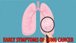 Lung cancer, also known as lung carcinoma, is a malignant lung tumor characterized by uncontrolled cell growth in tissues of the lung. Some Of The Early Common Symptoms Of Lung Cancer Iwmbuzz