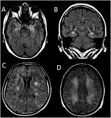 Encephalitis is an inflammation of the brain caused by an infection or through the immune system attacking the brain in error. Encefalitis Autoinmunes Criterios Diagnosticos Y Pautas Terapeuticas