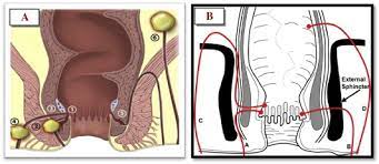 One way a fistula may form is from an abscess (pus in the body). A And B Coronal Diagrams Illustrate Types Of Ano Rectal Fistulas Download Scientific Diagram