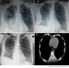 Systemic Lupus Erythematosus Presenting As Acute Lupus Pneumonitis Archivos De Bronconeumologia