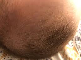 Otherwise, your eczema problem may progress and the treatment process may be prolonged. Baby S Super Dry Scalp October 2019 Babies Forums What To Expect