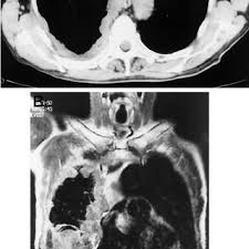 Benign tumors of the pleura. A 71 Year Old Patient With Pleural Mesothelioma Ct Scan Top A Download Scientific Diagram