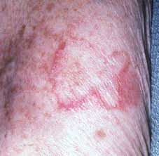 On darker skin, they will be more hyperpigmented (darker or patchy in color). Not All Round Rashes Are Ringworm A Differential Diagnosis Of Annular And Nummular Lesions 2018 10 18 Relias Media Continuing Medical Education Publishing