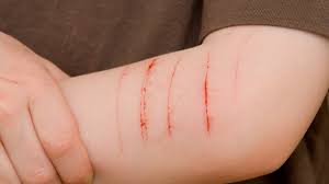 Bei einer persönlichkeitsstörung sind bestimmte wesenszüge. á… Borderline Syndrom Das Leben Zwischen Den Extremen