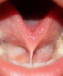 Information On Tongue Tied Babies Tongue Tie Speech Language Therapy Speech Therapy