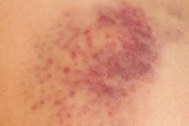 Purpura could also be caused by a minor trauma to your skin that causes your to have some hemorrhaging under the surface of your skin. Types Of Purpura Causes Symptoms Complications And Treatment