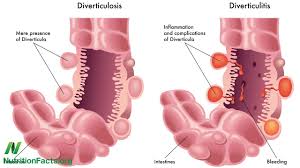 Ovarian cancer is a cancer beginning in the ovaries. Diverticulitis Physiopedia