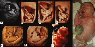Diagnosis Of Fetal Syndromes By Three And Four Dimensional Ultrasound Is There Any Improvement