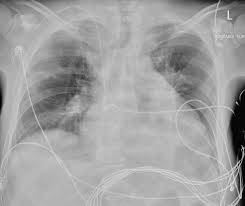 Image result for Cor Pulmonale