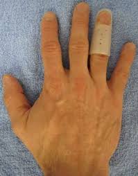 Mallet finger splint (438 результатов). Mallet Finger Physiopedia