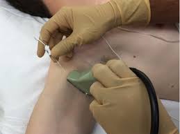 Image result for Axillary Nerve Block