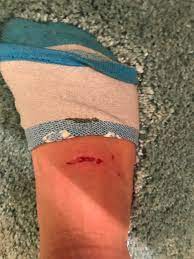 I Was Swimming With Fins On And I Got A Blister That Turned Into This Is There Anything That I Can Do To Prevent This Swimming