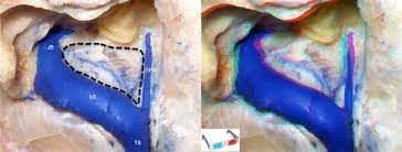 Such developmental changes most probably influence the endolymphatic absorptive system. Trautmann S Triangle Operative Neurosurgery