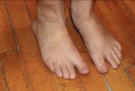 Image result for Foot Drop