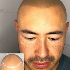FULL MICROPIGMENTATION
