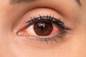 Decongestants and allergy meds work to dry up your sinuses, which could in turn cause your eyes to get red. How To Prevent Or Treat Red Eye Health Gadgetsng