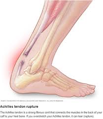 Achilles Tendon Rupture La Crosse Mayo Clinic Health System