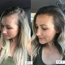 Postpartum Hair Monat Hair Treat Hair Fall Postpartum Hair Loss
