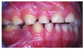 Image result for ochrana chrupu