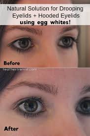 Maybe you would like to learn more about one of these? Natural Remedy For Drooping Eyelids Sagging Eyelids Or Hooded Eyes