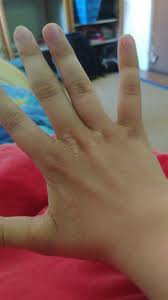 Neurodermitis wird in der medizin heute korrekterweise unter begriffen wie „atopisches ekzem oder auch so sind häufig der kopf, also kopfhaut und gesicht, aber auch die hände, armbeugen und. Was Ist Das An Meiner Hand Und Wieso Gesundheit Und Medizin Neurodermitis Trockene Haut