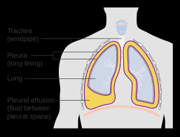 Obliteration of left costophrenic angle with a wide pleural based dome shaped opacity projecting into the lung noted tracking along the cardiophrenic angle and lateral chest wall suggestive of loculated pleural effusion, however the. Imaging Findings Of Free Flowing Effusion Online Medical Library