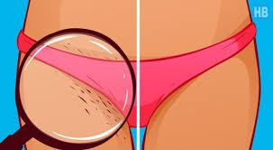 Such ingrown hair can leave scars. Oh No Bad Ingrown Hairs After Brazilian Wax What To Do