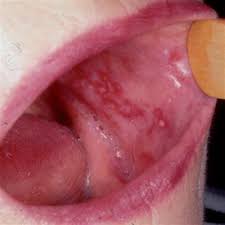 Image result for lichen planus on tongue)