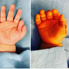 Image result for Polydactyly