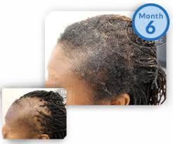 By kenneth | click here to learn how to go natural and grow long hair in less than 30 days. How Cornrows And Other Protective Hairstyles Can Cause Hair Loss