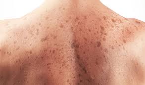 Image result for skin cancer