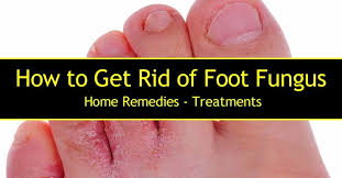 how to get rid of foot fungus home
