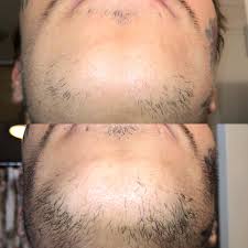 Historically, it's had the baddest rap of all the facial hair expressions. Month One Vs Month Three You Might Have Bad Facial Hair Genetics But They Re Not Worse Than Mine Never Had Any Facial Hair Before Minox Applying Once Per Day Sometimes Twice Derma