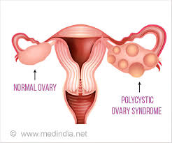 Likewise, while some research indicates a possible relationship between pcos and ovarian cancer, the human reproduction update suggests that you're no more likely to develop ovarian cancer than someone without pcos. No Need For Surgical Removal Of Non Cancerous Ovarian Cysts