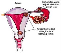 Kehamilan ektopik atau juga dikenal sebagai kehamilan di luar kandungan merupakan suatu kondisi kehamilan dimana sel telur yang sudah. Tahukan Anda Kehamilan Ektopik Hamil Di Luar Kandungan Biologine Pak Mycunk