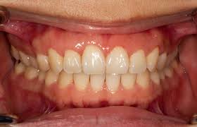 Having healthy gums isn't hard: Gum Disease Symptoms And Treatment Cuckfield Dental