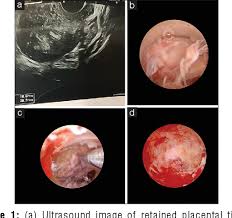 Image result for Retained Placenta