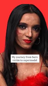 From a burn victim to walking with grace in a bikini…, My life changed when  I was just 5. I was playing with my friends when boiling hot water spilled 