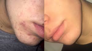 How to use tretinoin for acne. Tretinoin For Acne Usage Benefits Efficacy And Side Effects