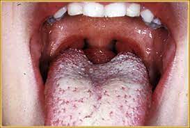 Ea se numeste si limba plicaturata, limba scrotala, limba brazdata de santuri. 8 Probleme De Sanatate Tradate De Limba Incarcata Buna Ziua Iasi Bzi Ro