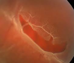 It's often accompanied by the sudden onset of symptoms such as floaters and flashing lights. Retinal Tears And Detachment