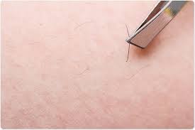 In the case of an ingrown hair, the hair grows sideways back into the skin through the follicle wall. Preventing Ingrown Hairs